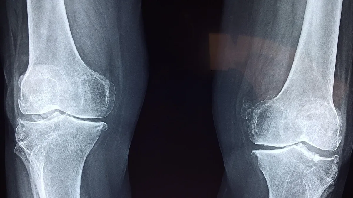 Hypermobility Spectrum Disorders, connective tissue conditions causing joint pain and fatigue, affect hundreds of...