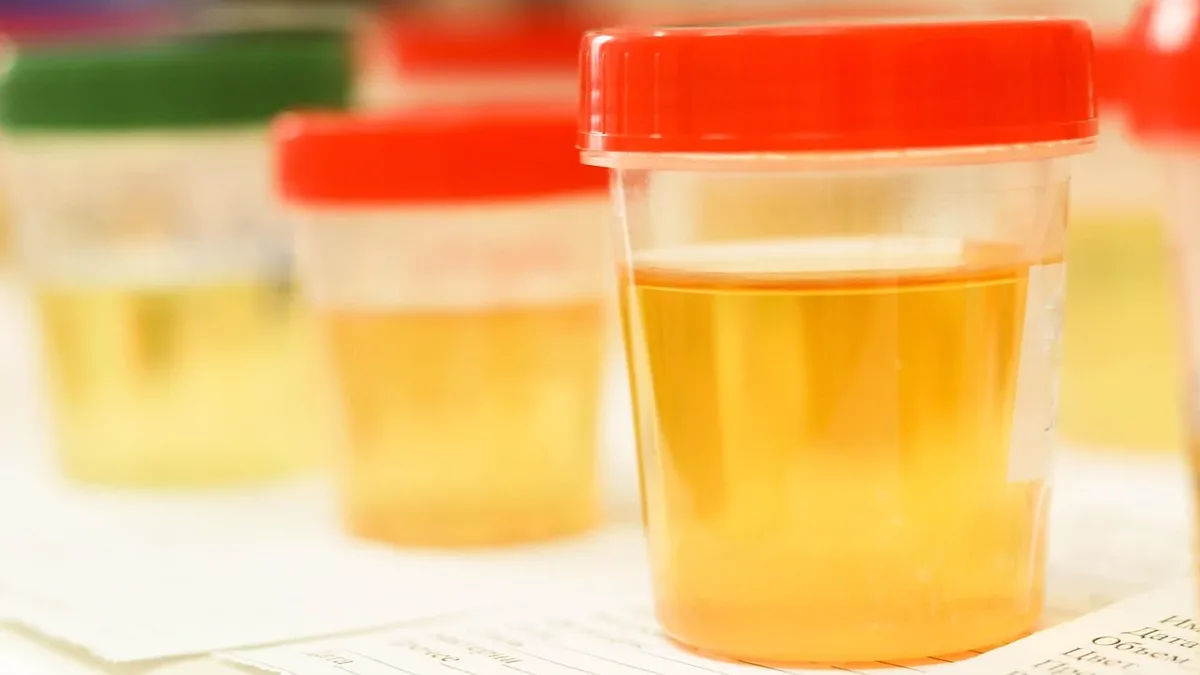 A new at-home urine test trialled by the NHS can identify 92% of bladder cancer cases, potentially reducing the need for...