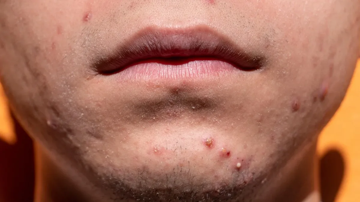 A new photo series explores how pimple patches are changing teenagers' relationship with acne, moving from stigma to a...